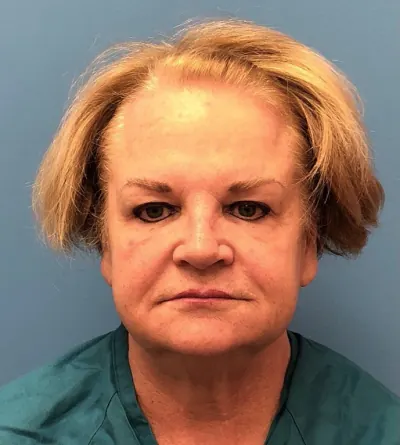 Facelift Case #14460 — before, Dr. Samir Rao