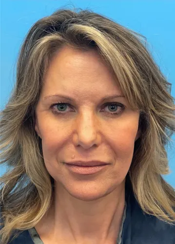 Facelift Case #18078 — after, Dr. Samir Rao