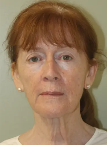 Facelift Case #1951 — before, Dr. Arjun Kanuri