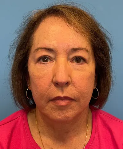 Facelift Case #21241 — after, Dr. Samir Rao