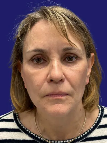 Facelift Case #2269336 — after, Dr. Frank Albino