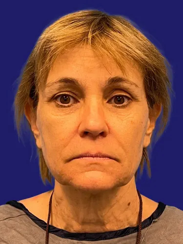 Facelift Case #2269336 — before, Dr. Frank Albino