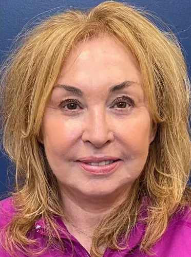 Facelift Case #22860 — after, Dr. Samir Rao