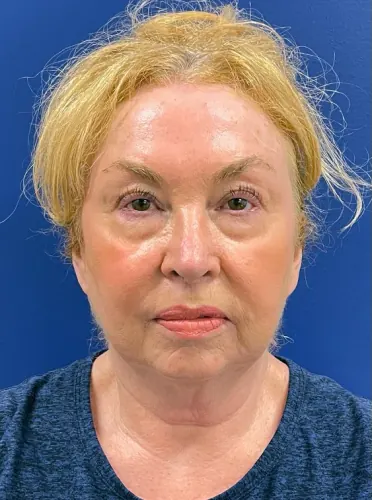Facelift Case #22860 — before, Dr. Samir Rao