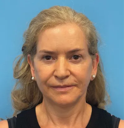 Facelift Case #292 — after, Dr. Samir Rao