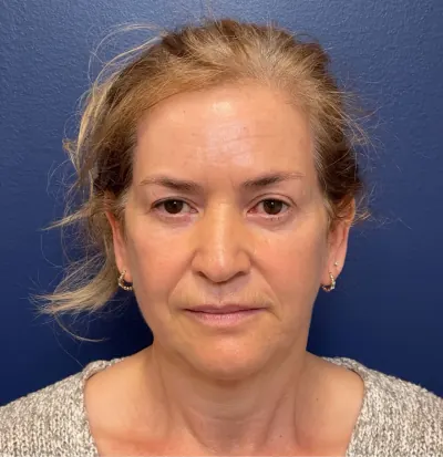 Facelift Case #292 — before, Dr. Samir Rao