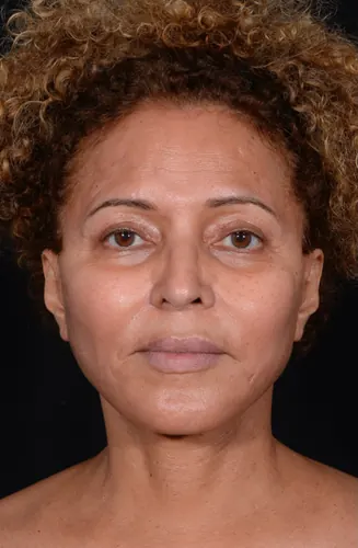 Facelift Case #360 — after, Dr. Arjun Kanuri
