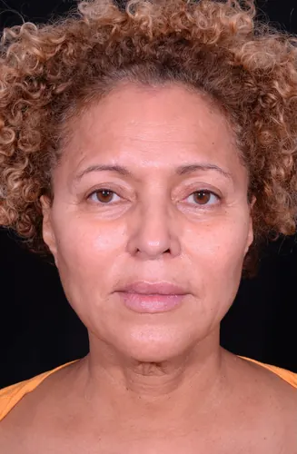 Facelift Case #360 — before, Dr. Arjun Kanuri