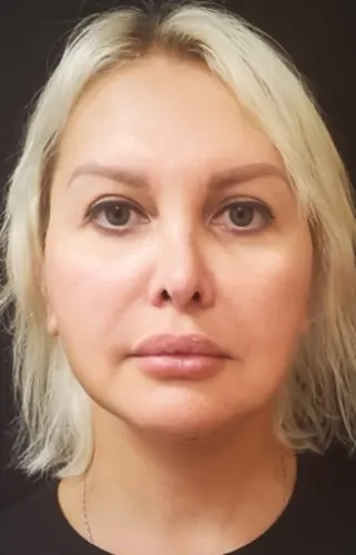 Facelift Case #362 — after, Dr. Arjun Kanuri
