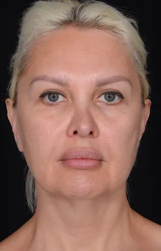 Facelift Case #362 — before, Dr. Arjun Kanuri
