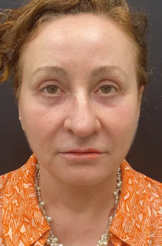 Facelift Case #363 — after, Dr. Arjun Kanuri