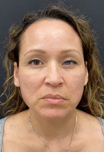 Facelift Case #364 — after, Dr. Arjun Kanuri