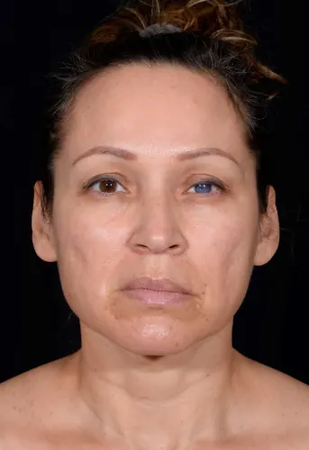 Facelift Case #364 — before, Dr. Arjun Kanuri