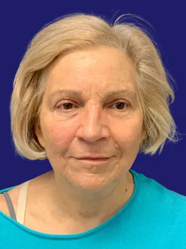 Facelift Case #3746 — after, Dr. Frank Albino
