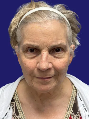 Facelift Case #3746 — before, Dr. Frank Albino