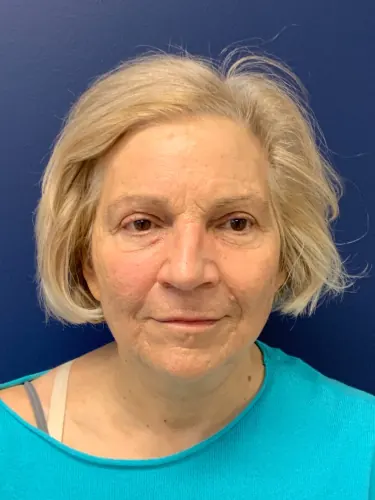 Facelift Case #3746 — after, Dr. Frank Albino