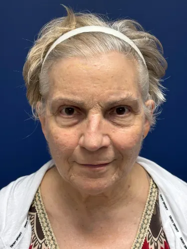 Facelift Case #3746 — before, Dr. Frank Albino