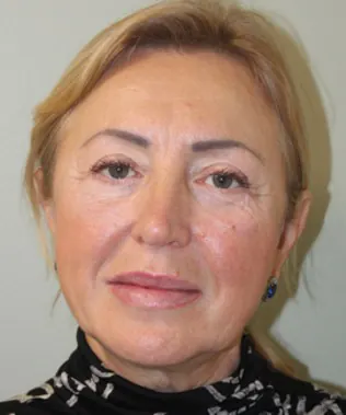 Facelift Case #401 — after, Dr. Arjun Kanuri