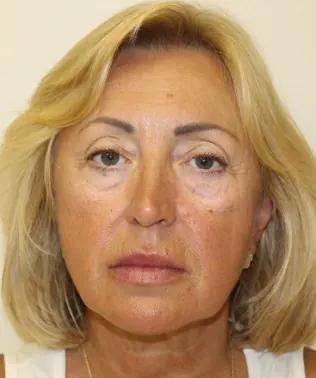 Facelift Case #401 — before, Dr. Arjun Kanuri