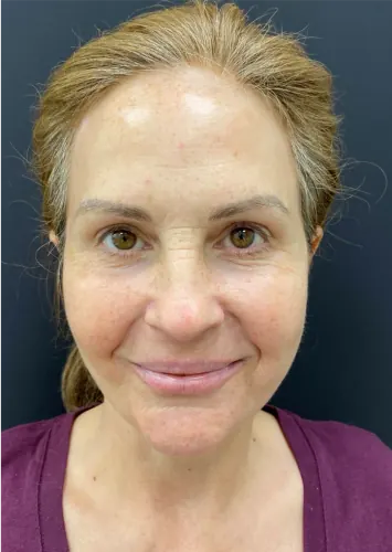 Facelift Case #4160 — after, Dr. Arjun Kanuri