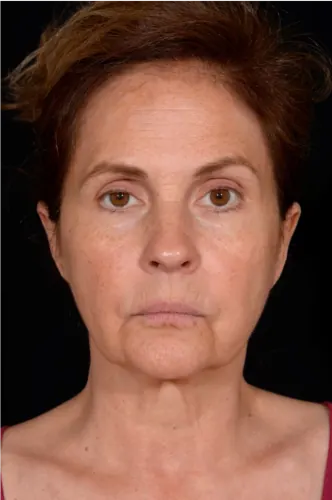 Facelift Case #4160 — before, Dr. Arjun Kanuri