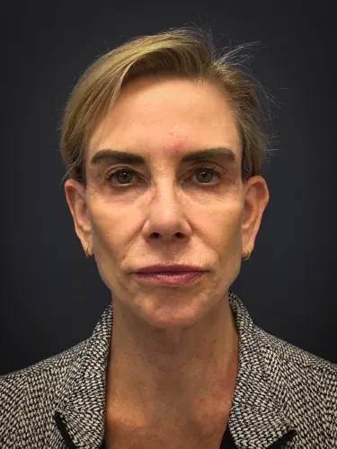 Facelift Case #4219 — after, Dr. Samir Rao