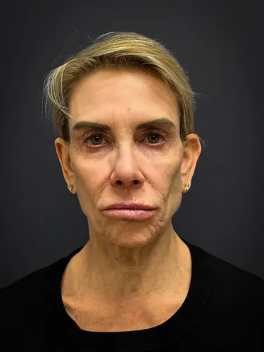 Facelift Case #4219 — before, Dr. Samir Rao