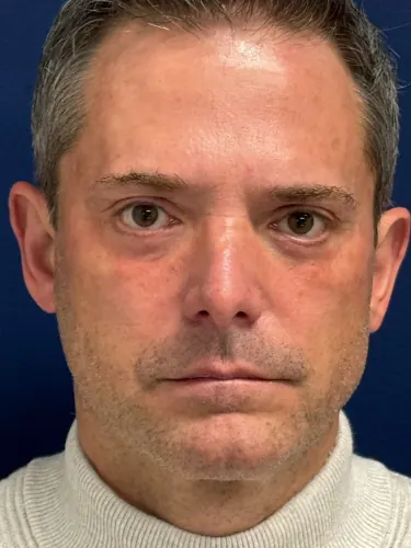 Facelift Case #5450 — after, Dr. Frank Albino