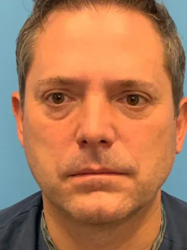 Facelift Case #5450 — before, Dr. Frank Albino