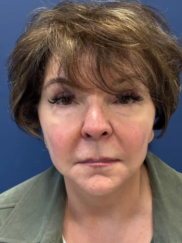 Facelift Case #6613 — after, Dr. Frank Albino