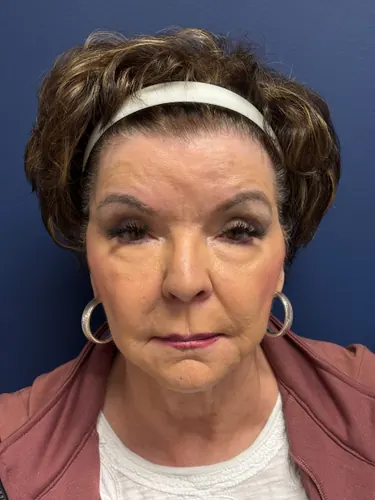 Facelift Case #6613 — before, Dr. Frank Albino
