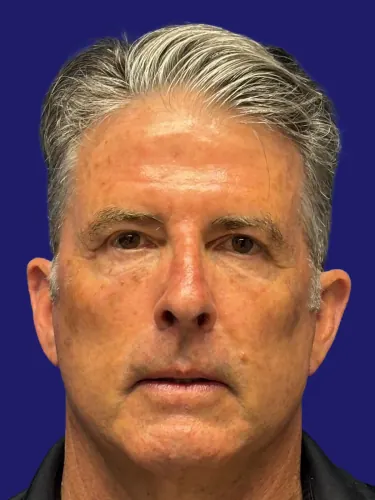 Facelift Case #7129969 — after, Dr. Frank Albino