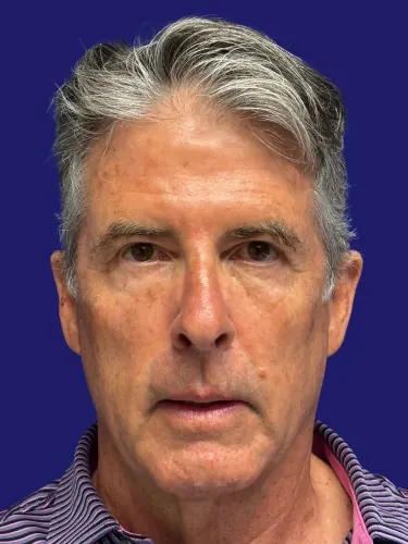 Facelift Case #7129969 — before, Dr. Frank Albino
