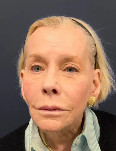 Facelift Case #7247 — after, Dr. Arjun Kanuri