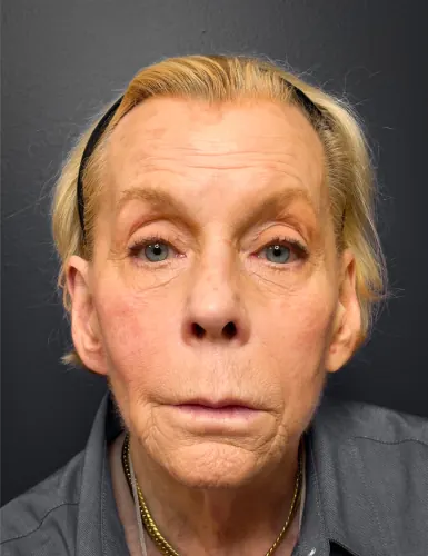 Facelift Case #7247 — before, Dr. Arjun Kanuri