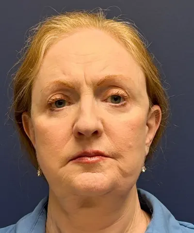 Eyelid Surgery Case #7934 — after, Dr. Arjun Kanuri