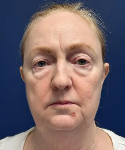 Eyelid Surgery Case #7934 — before, Dr. Arjun Kanuri