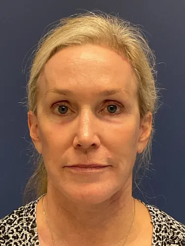 Brow Lift Case #4522 — after, Dr. Arjun Kanuri