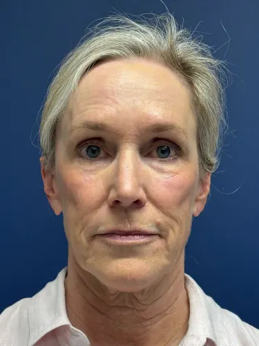 Brow Lift Case #4522 — before, Dr. Arjun Kanuri