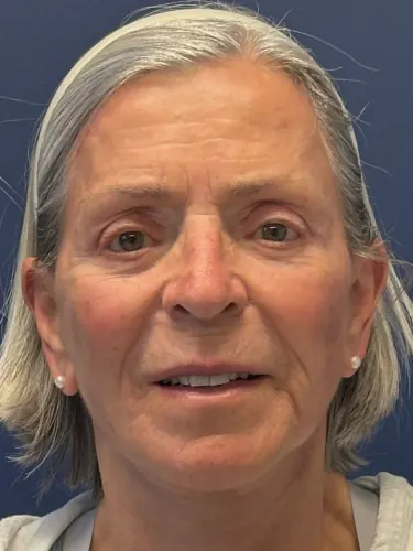 Brow Lift Case #1088 — after, Dr. Arjun Kanuri