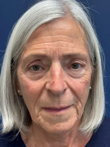 Brow Lift Case #1088 — before, Dr. Arjun Kanuri