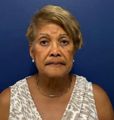Face360 Case #4262 — before, Dr. Arjun Kanuri