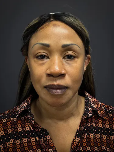 Eyelid Surgery Case #6866 — before, Dr. Samir Rao