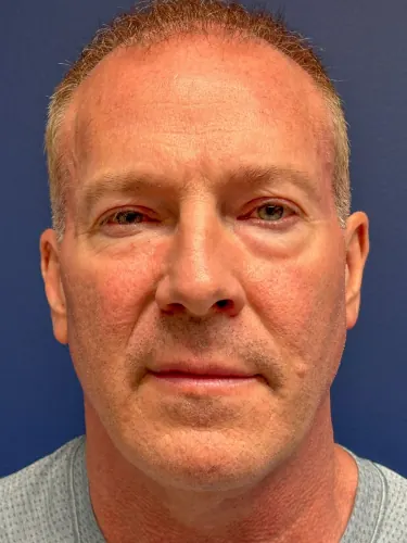 Eyelid Surgery Case #facelift-necklift-blepharoplasty — before, Dr. Arjun Kanuri