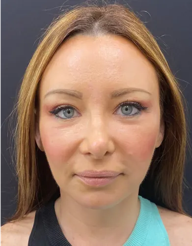 Facelift Case #1679 — after, Dr. Arjun Kanuri