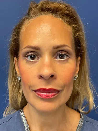 Facelift Case #4152 — after, Dr. Arjun Kanuri