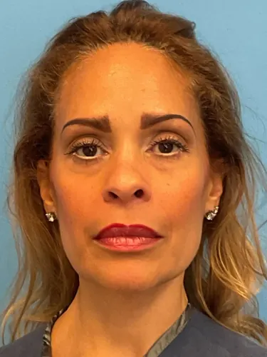 Facelift Case #4152 — before, Dr. Arjun Kanuri