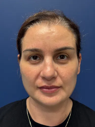Facelift Case #7977 — after, Dr. Arjun Kanuri