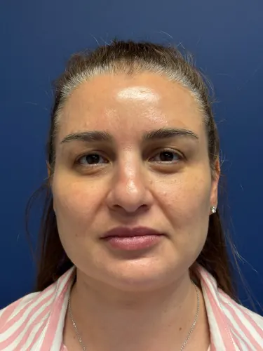 Facelift Case #7977 — before, Dr. Arjun Kanuri