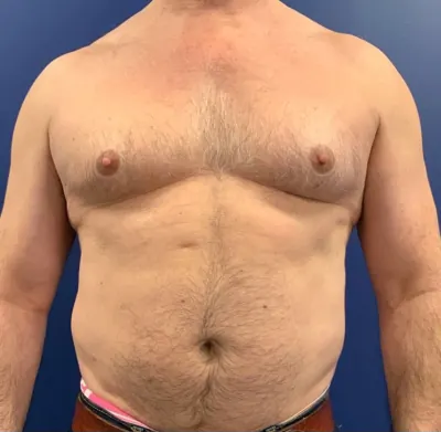 Gynecomastia / Male Breast Reduction Case #20376 — before, Dr. Frank Albino